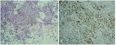 Case report: Evaluation of myocardial microcirculation in patients with breast cancer after anthracycline chemotherapy by using intravoxel incoherent motion imaging